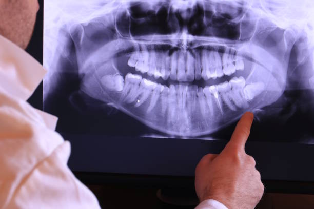 Best Emergency Wisdom Teeth Removal in Wadsworth, IL